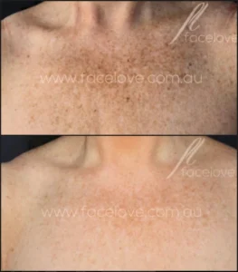 IPL Skin Treatment Before and After Facelove Medispa St Kilda 9