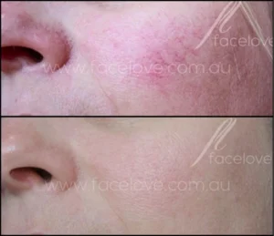 IPL Skin Treatment Before and Afters Facelove Medispa St Kilda 13