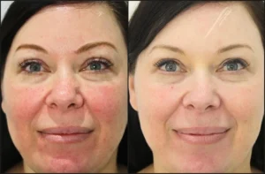 IPL Skin Treatment Before and Afters Facelove Medispa St Kilda 12