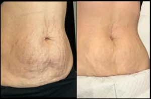 Secret RF Microneedling Before and After Facelove Medispa St Kilda 3