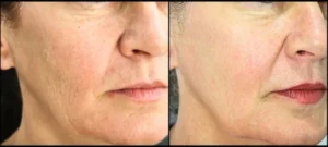 Secret RF Microneedling Before and After Facelove Medispa St Kilda 2
