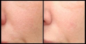 Skin Needling Before and Afters Facelove Medispa (1)