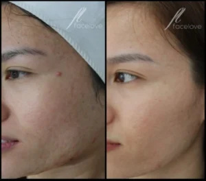 Skin Needling Treatment Before and Afters Facelove Medispa St Kilda