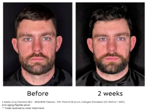 2 weeks of Facelove Skin - acne front