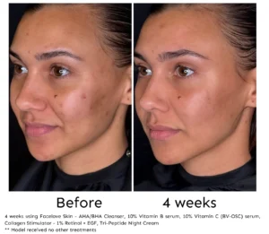 4 weeks of Facelove Skin skincare treatment - Acne & Scars before and afters