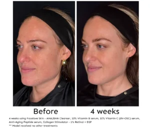 Before and after 4 weeks of Facelove Skin skincare - Pigmentation
