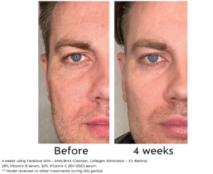 Before and after 4 weeks of Facelove Skin Skincare - Pigmentation Treatment