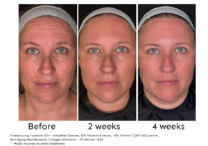 Before and after 4 weeks of Facelove Skin skincare treatment - Pores Treatment