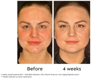 Before and after 4 weeks of Facelove Skin skincare treatment - skin redness treatment