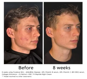 Before and after 8 weeks of Facelove Skin skincare treatment - acne and scars treatment