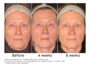 Before and after 8 weeks of Facelove Skin skincare treatment - anti ageing treatment